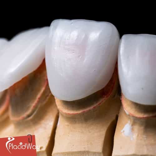 Cosmetic Dentistry in Mexico: Enhance Your Smile with Affordable Veneers for New Mexico Patients